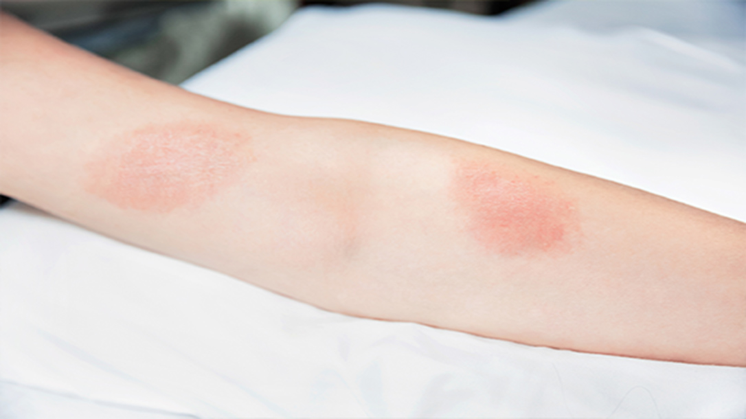 Poison ivy presents itself on th e skin as itchy red blotches.