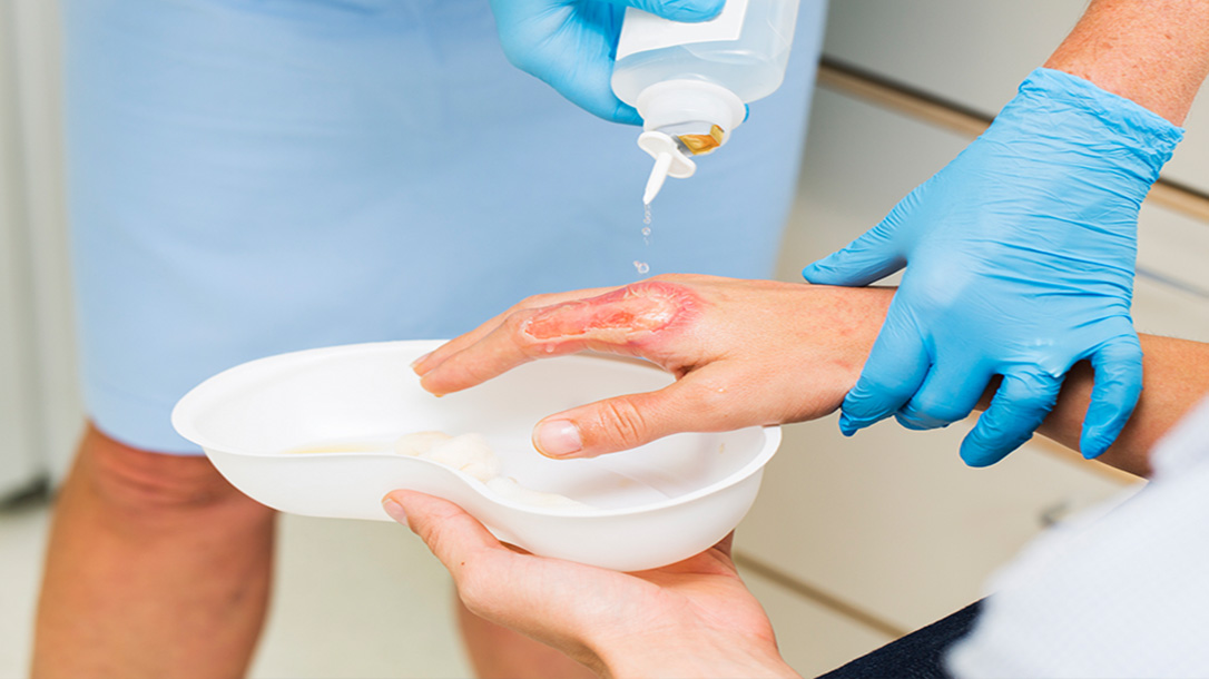 Learn how to treat a burn correctly.